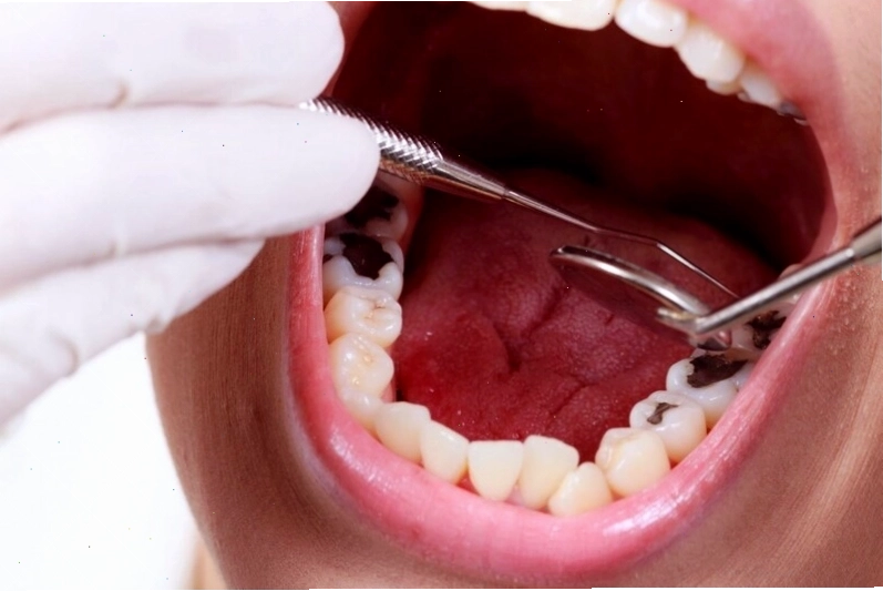 Khám răng định kỳ giúp phát hiện sớm các bệnh lý và điều trị kịp thời