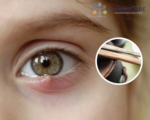 Mẹo chữa lẹo mắt dân gian: Giải pháp an toàn và hiệu quả tại nhà