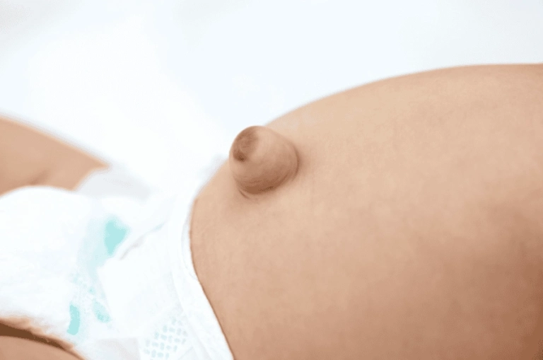 Mẹo Chữa Rốn Lồi Ở Trẻ Sơ Sinh An Toàn và Hiệu Quả