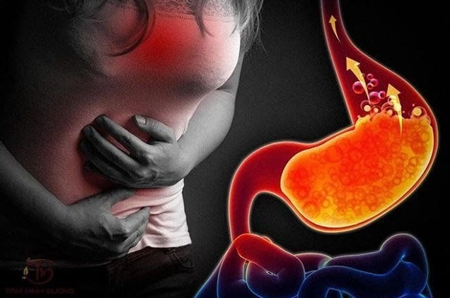 Mẹo Chữa Trào Ngược Dạ Dày Thực Quản Hiệu Quả Tại Nhà