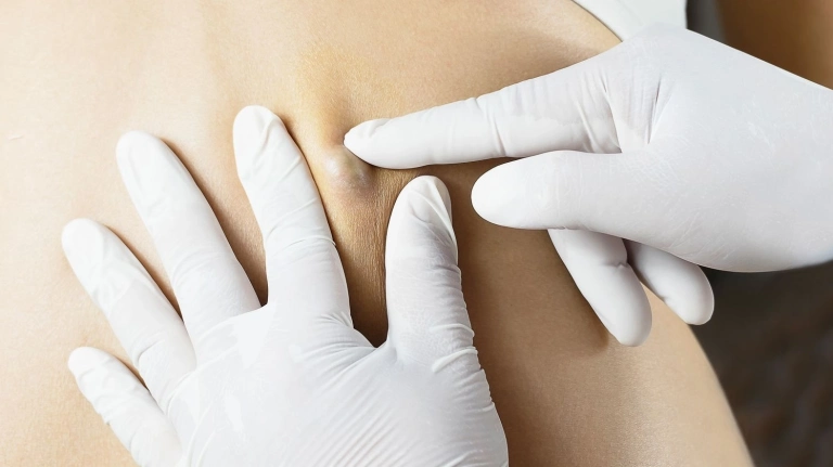 Mẹo dân gian chữa u bã đậu: An toàn hay tiềm ẩn rủi ro?