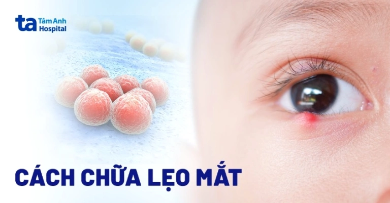 Mẹo Trị Lẹo Mắt Nhanh Nhất Tại Nhà Hiệu Quả Trong Một Nốt Nhạc